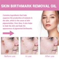 thumbnail image 3 of 1/2Pcs Birthmark Remover Oil Birthmark Lightening Oil, 3 of 5