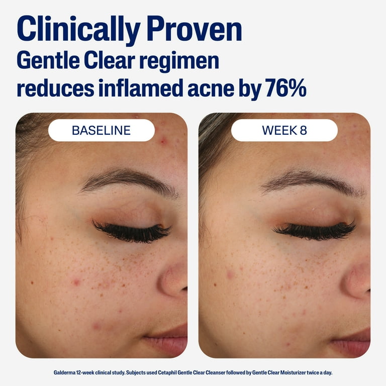 Cetaphil Gentle Clear Mattifying Acne Moisturizer With Salicylic