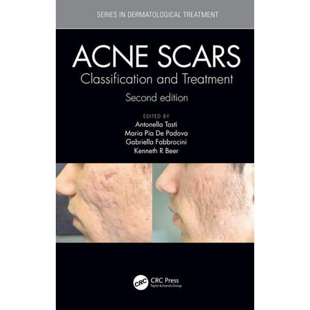 Acne Scars : Classification and Treatment, Second (The Best Way To Get Rid Of Acne Scars)