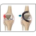 thumbnail image 5 of BioSkin OA Spiral Dynamic Unloading Knee Brace (RightMedial/LeftLateral, Small), 5 of 5