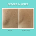 thumbnail image 6 of Bliss Clear Genius Body Acne Spray with Salicylic Acid For All Skin Types, 3.5 fl oz, 6 of 8