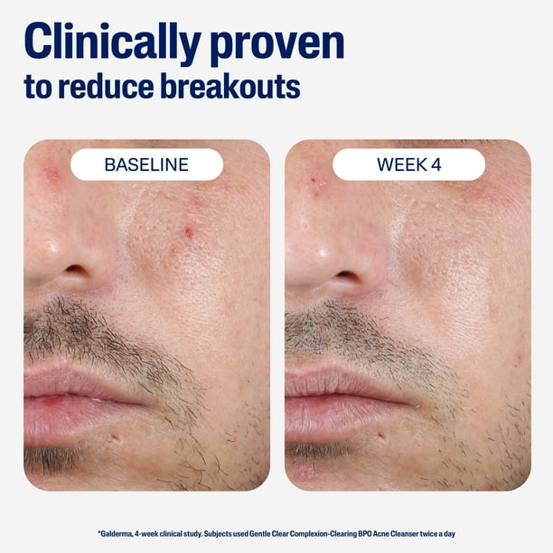 Cetaphil Gentle Clear Complexion-Clearing BPO Acne Cleanser for