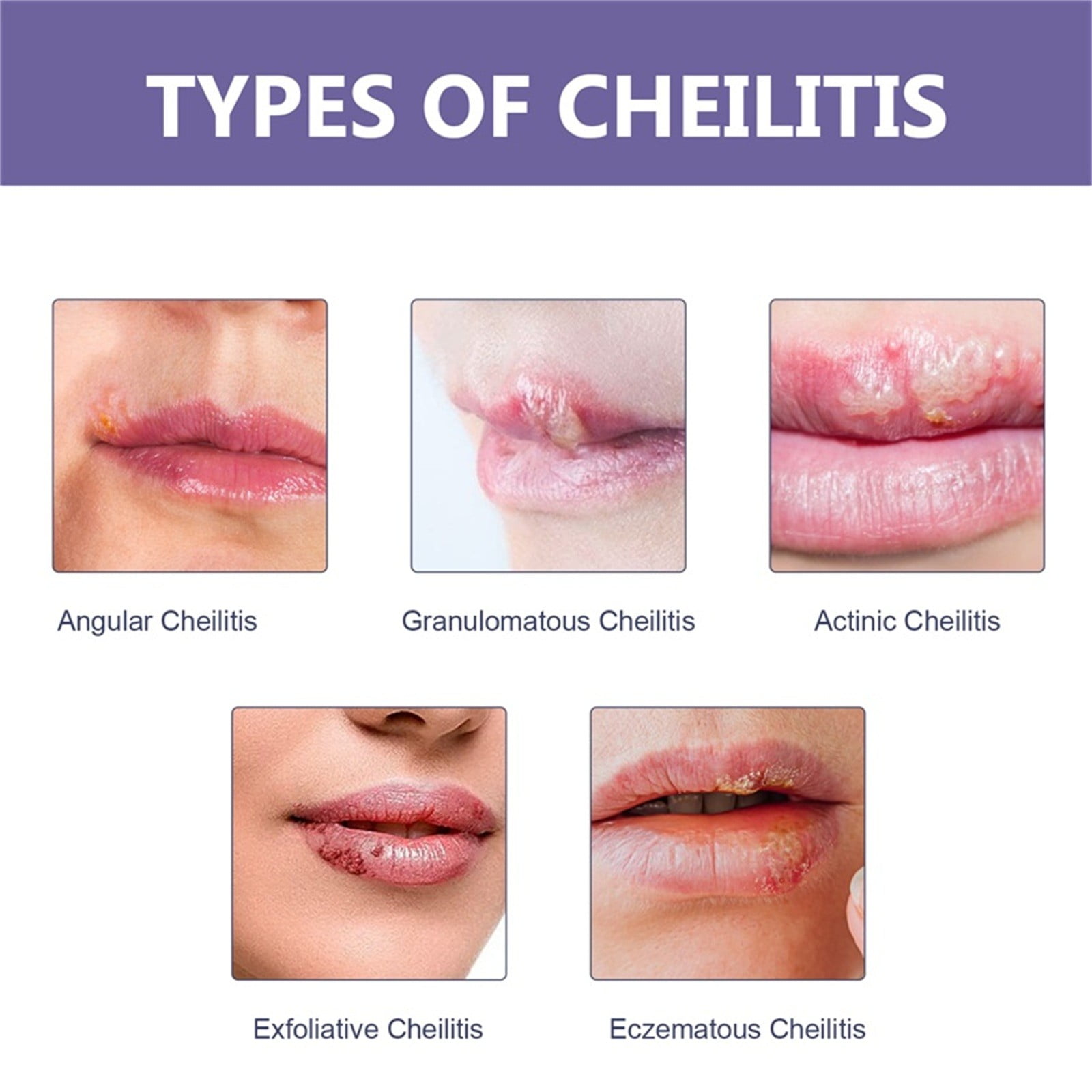 Angular Cheilitis: 5 Stages You Need To Know (With Pictures!) - mp0ya39