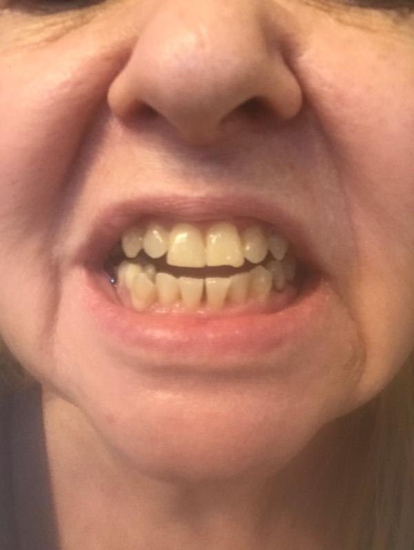 How to use brilliant tooth whitening kit