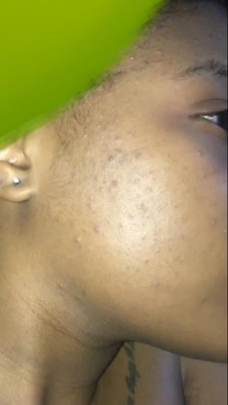 noxzema ultimate clear pads