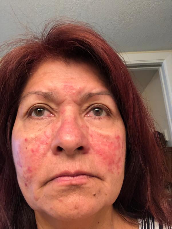 bb anti redness cream