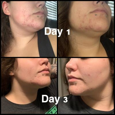 cerave acne foaming cleanser reviews