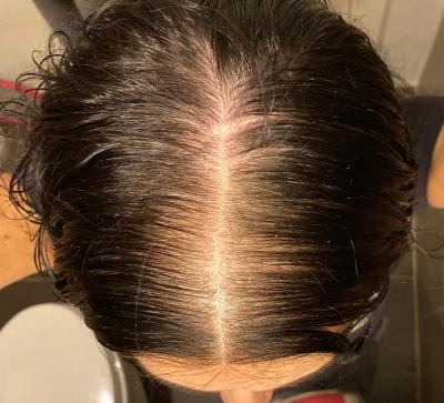 Equate Women S Minoxidil Topical Solution For Hair Regrowth 3