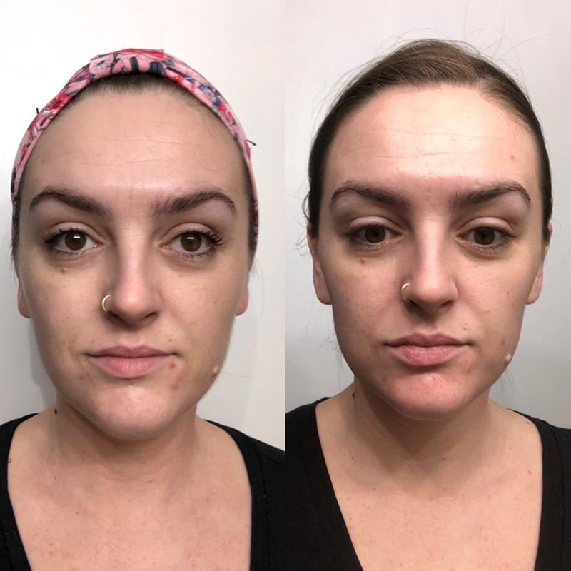 revitalift before and after