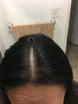 Equate Women S Minoxidil Topical Solution For Hair Regrowth 3