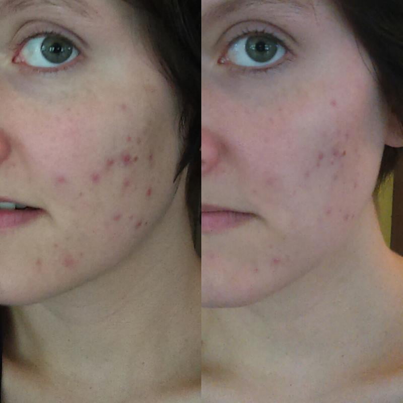 bioré charcoal acne clearing cleanser before and after