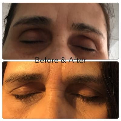 revitalift eye filler