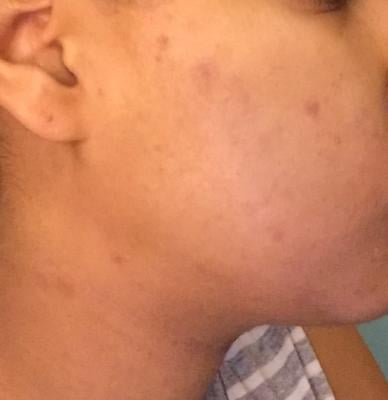 differin gel acne treatment walmart