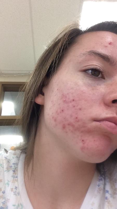 adapalene cystic acne