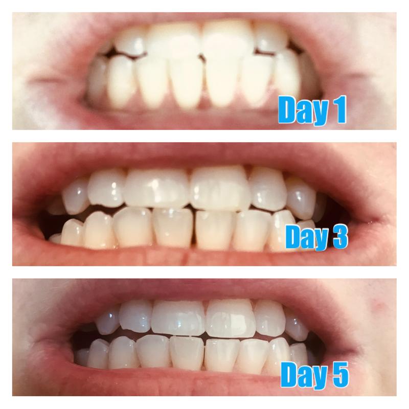 supersmile toothpaste before and after