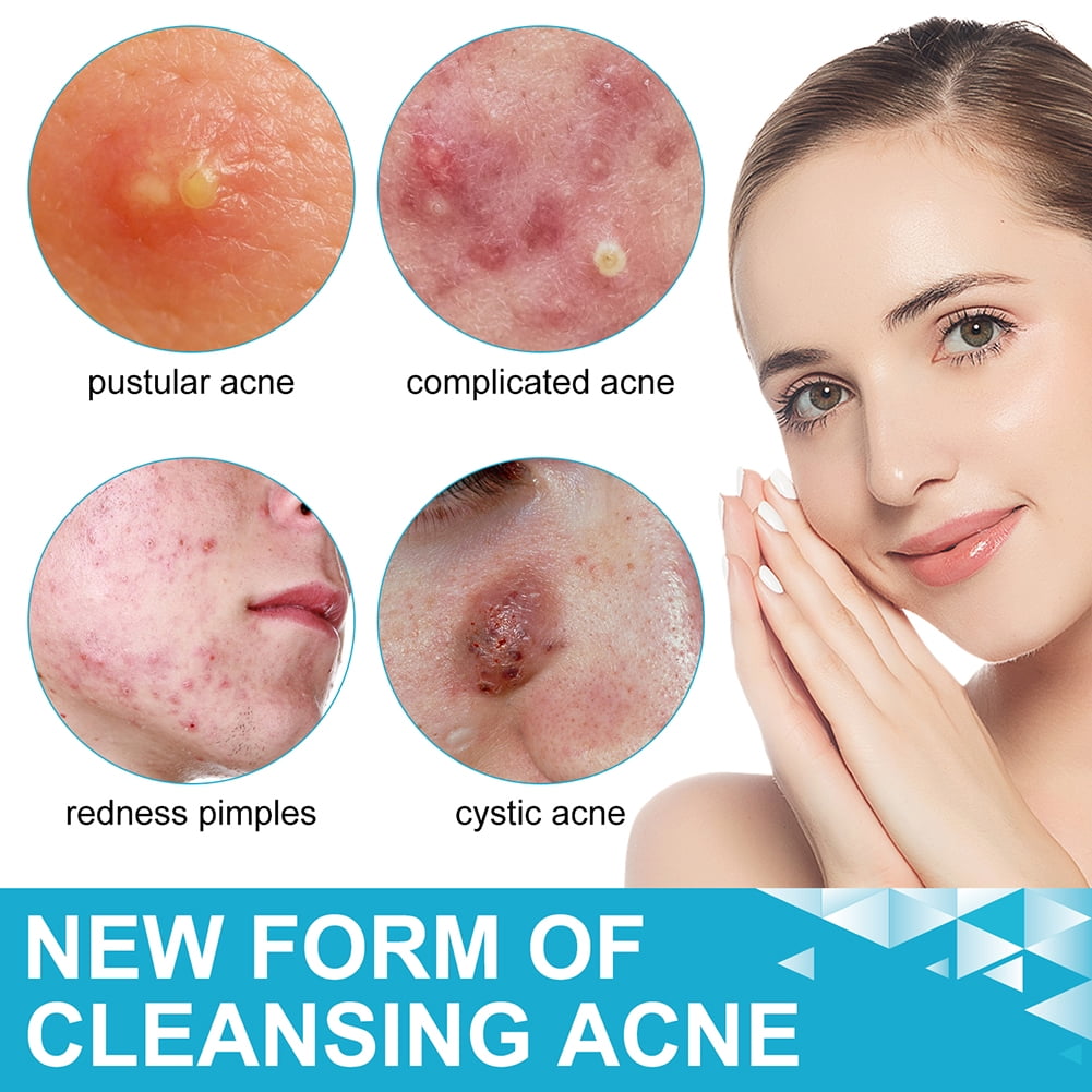 15pcs Peach Slices Deep Blemish Microdarts Acne Patch Early