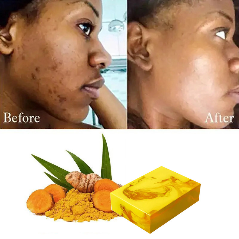 Kojic Acid Turmeric Soap for Hyperpigmentation,Brighhitening .Handmade Soap Brightening skin
