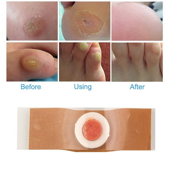 12Pcs/Set Foot Corn Remover Foot Pad Patches Removal Fast Recovering