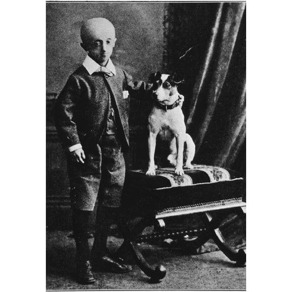 15 Year Old Boy With Progeria History (18 x 24)