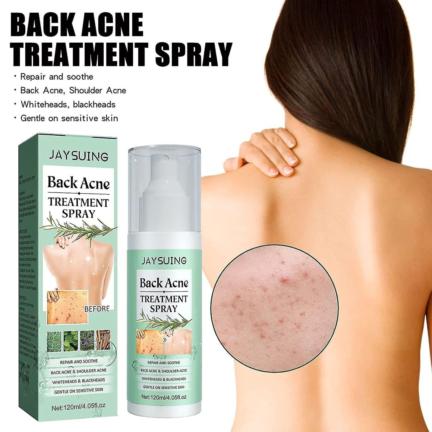  Clean Skin Club Acne Mist, Salicylic Acid Spot Treatment,  Dramatic Improving Results, The Only Spray that Combats & Prevents for  Face, Body and Back, Breakout Fighting Dots, Dark Spots, Pimples 