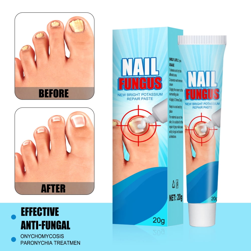 20g Nail Repair Cream Fast Absorption Onychomycosis Treatment Mild