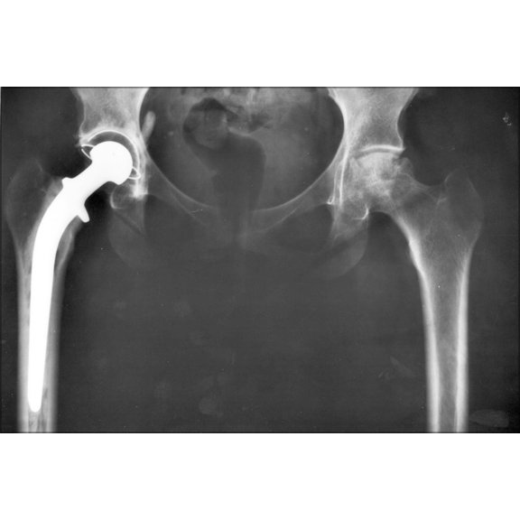 24"x36" Gallery Poster, Hip replacement Image 3684 PH