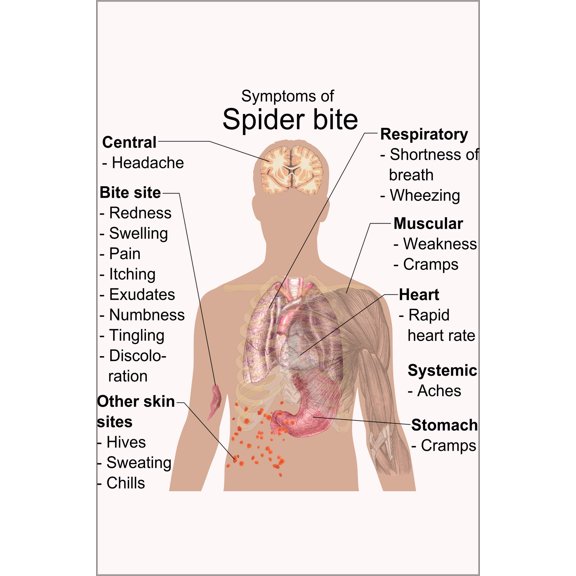 24"x36" Gallery Poster, Symptoms of Spider bite