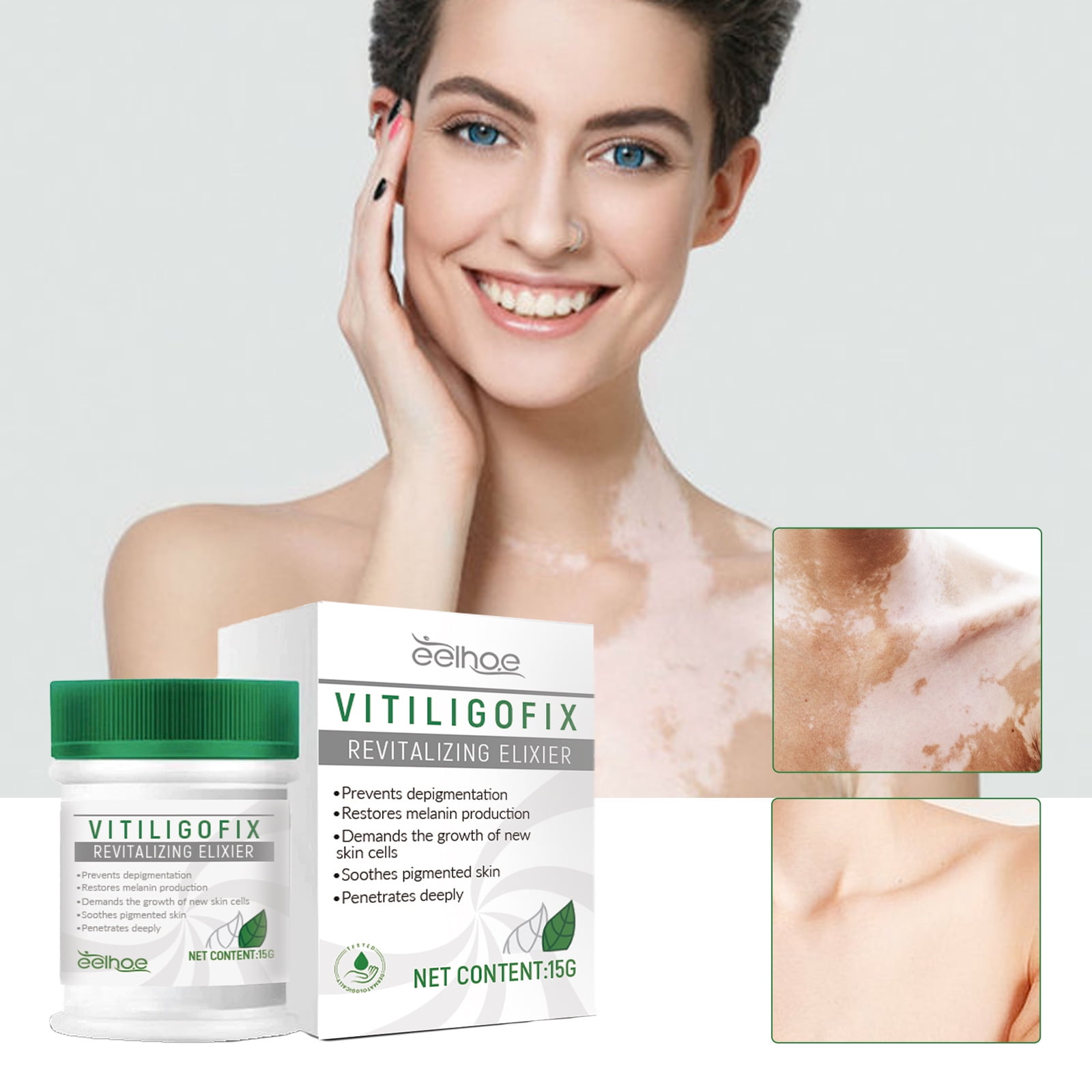 2PCS 15g Vitiligo Treatment Cream, Vitiligo Soothing Cream, Vitiligo