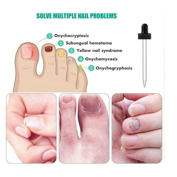 2PCS Kerassentials for Toenail, Kerassentials Toenail Treatment, Extra
