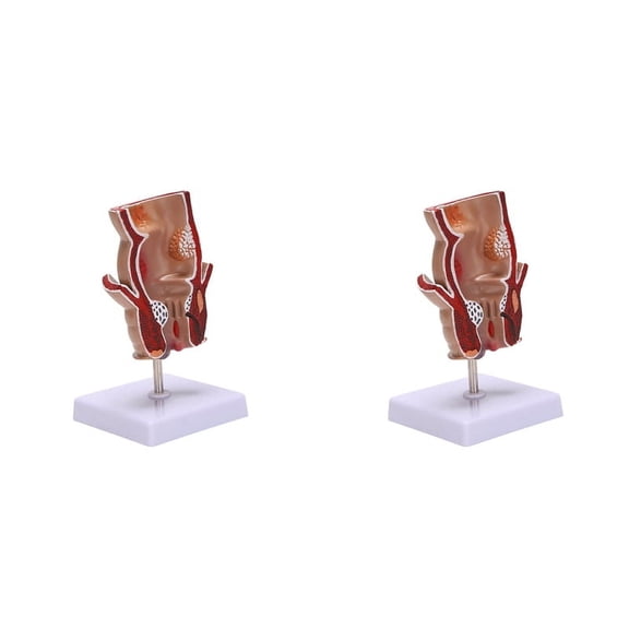 2X Anatomy Model Human Rectal Lesion Model Fistula Fistula Fissure Pathology Teaching Model