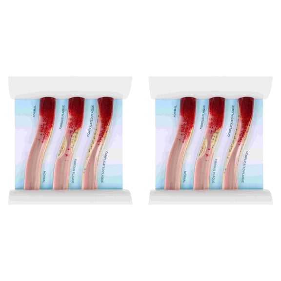 2X Dynamic Blood Vessel Model Cardiovascular Blockage Contrast Model Thrombosis Model for Teaching Explanation