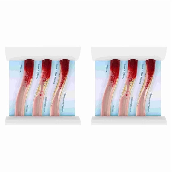 2X Dynamic Blood Vessel Model Cardiovascular Blockage Contrast Model Thrombosis Model for Teaching Explanation