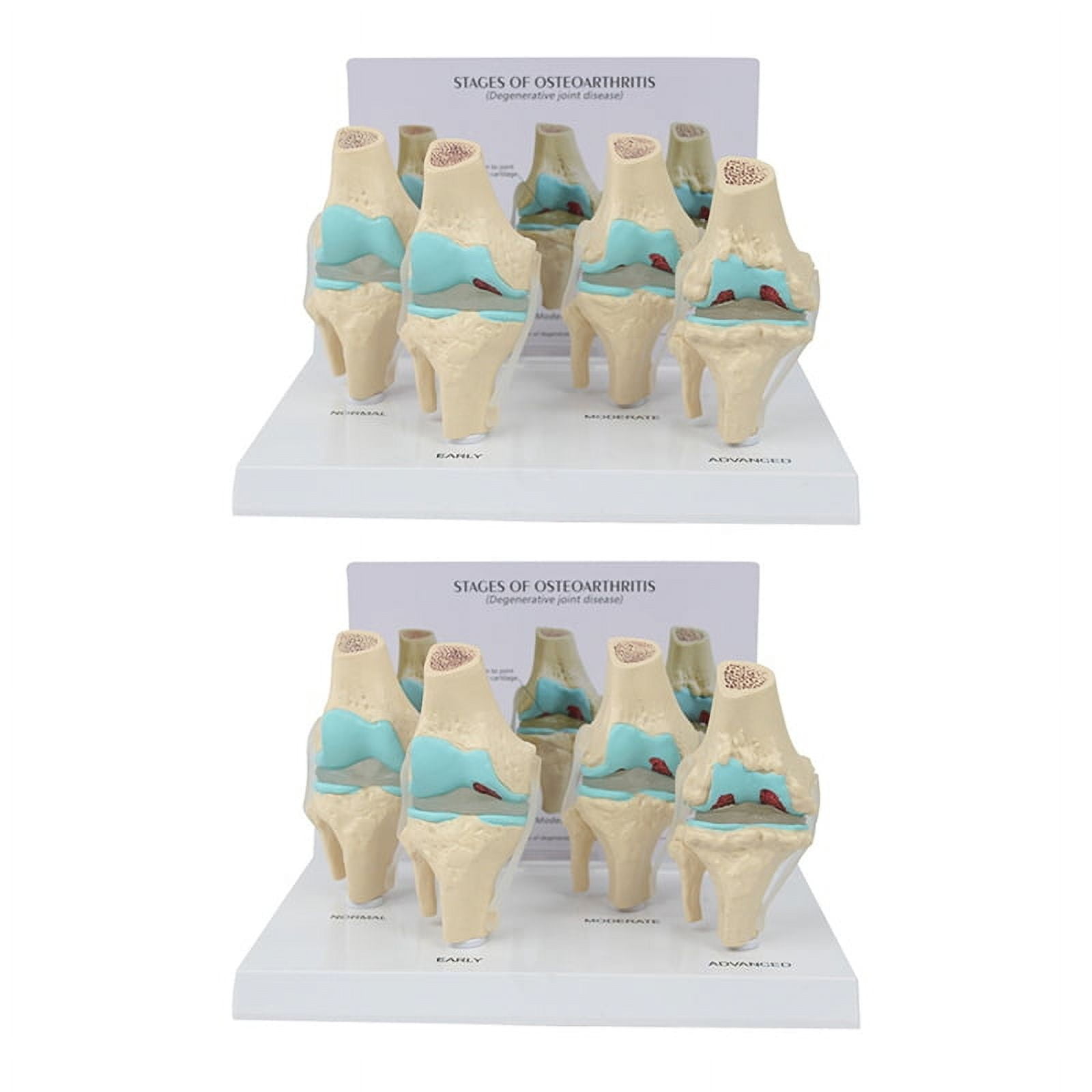 2X Knee Kit Osteoarthritis Anatomy Model with Educational Key Card 4 ...