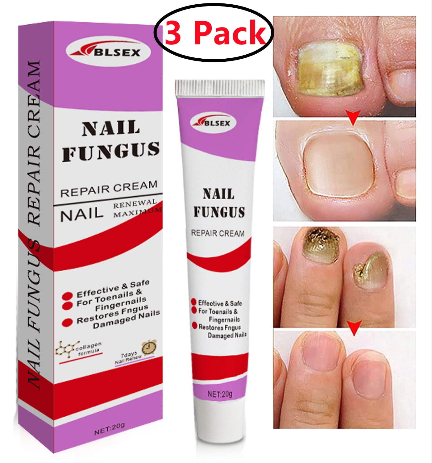 3 Pack Foot Fungus Treatment Extra Strength with Miconazole