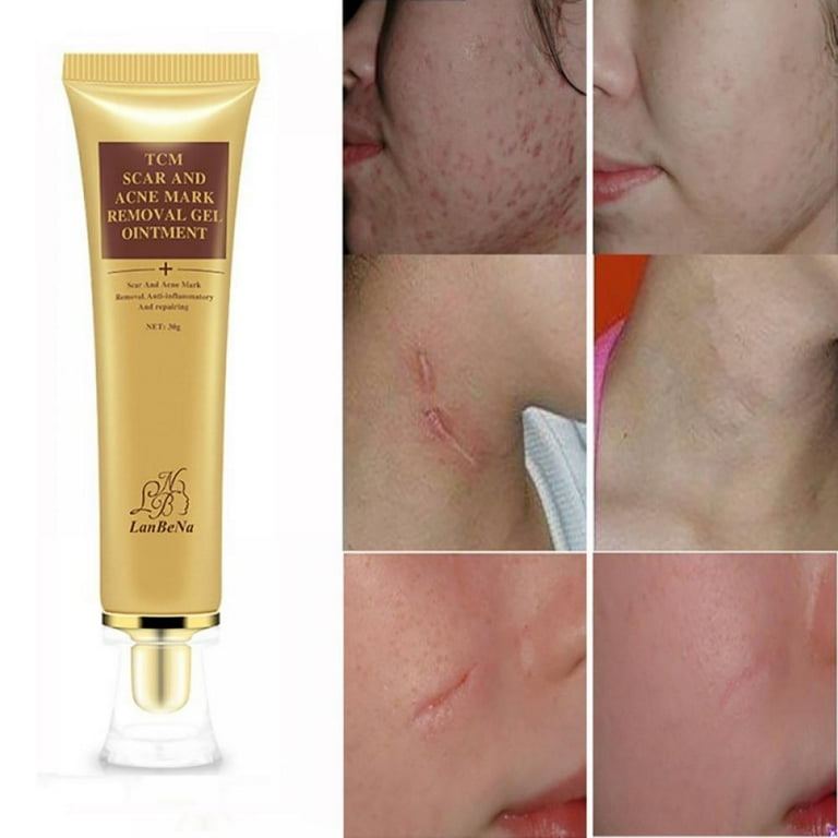 Acne marks cheap removal cream