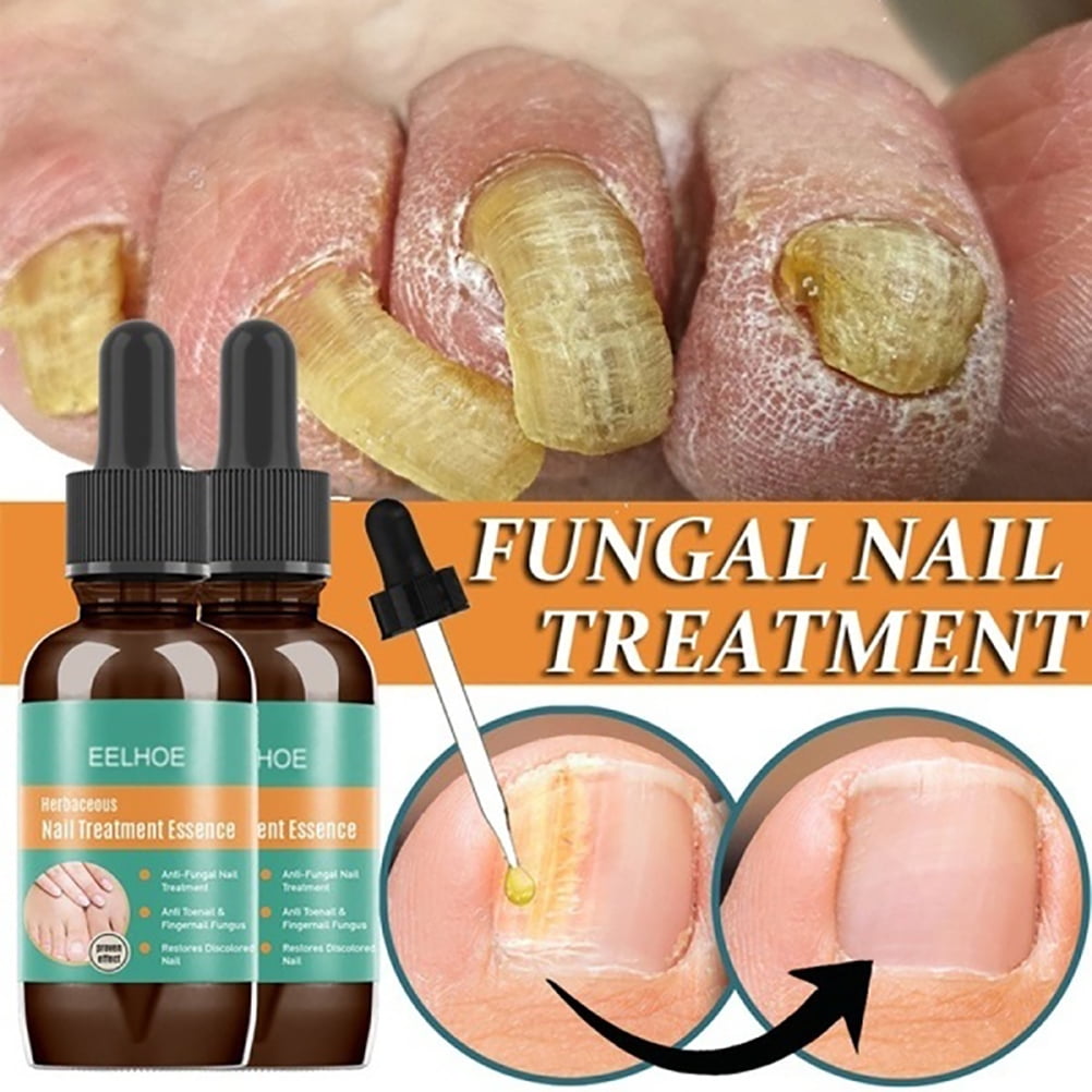 Anti Fungal Nail Treatment Finger Toe Care Fungus Fungi Liquid Repair Pen  Remove | eBay