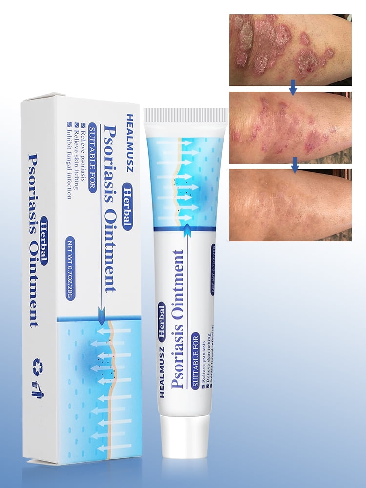 3pcs Psoriasis Cream For Dermatitis And Eczema Herbal Medicine Ointment