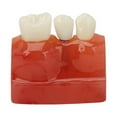 4 Times Dental Implant Model Crown Bridge Implant Teeth Demonstration