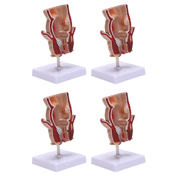 4X Anatomy Model Human Rectal Lesion Model Fistula Fistula Fissure Pathology Teaching Model