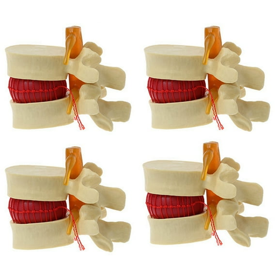 4X Lumbar Vertebrae Model Anatomical Spine Lumbar Disc Herniation Anatomy Teaching Tool Lumbar Vertebrae Model