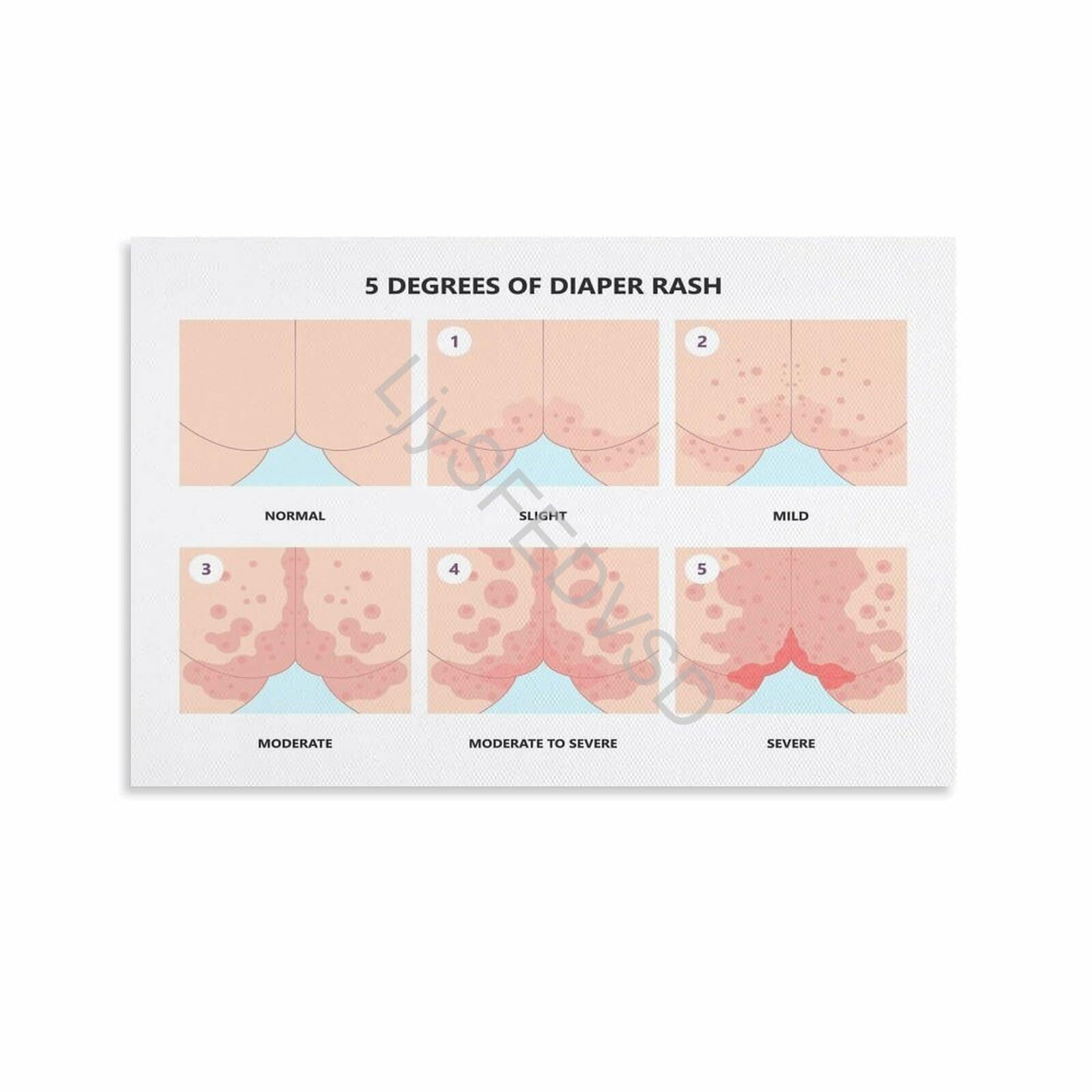 General Rash Poster 5 Degrees of Diaper Rash Severity Chart Poster Baby Skin Care Guide ...