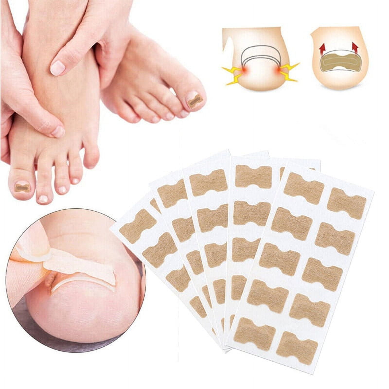 Sticker Corrector 50Pcs Ingrown Toenail Corrector Patches Nail Correction Care Stickers ...