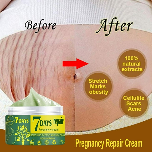 acdanc 50g Pregnancy Stretch Mark Repair Cream Maternity Obesity Skin