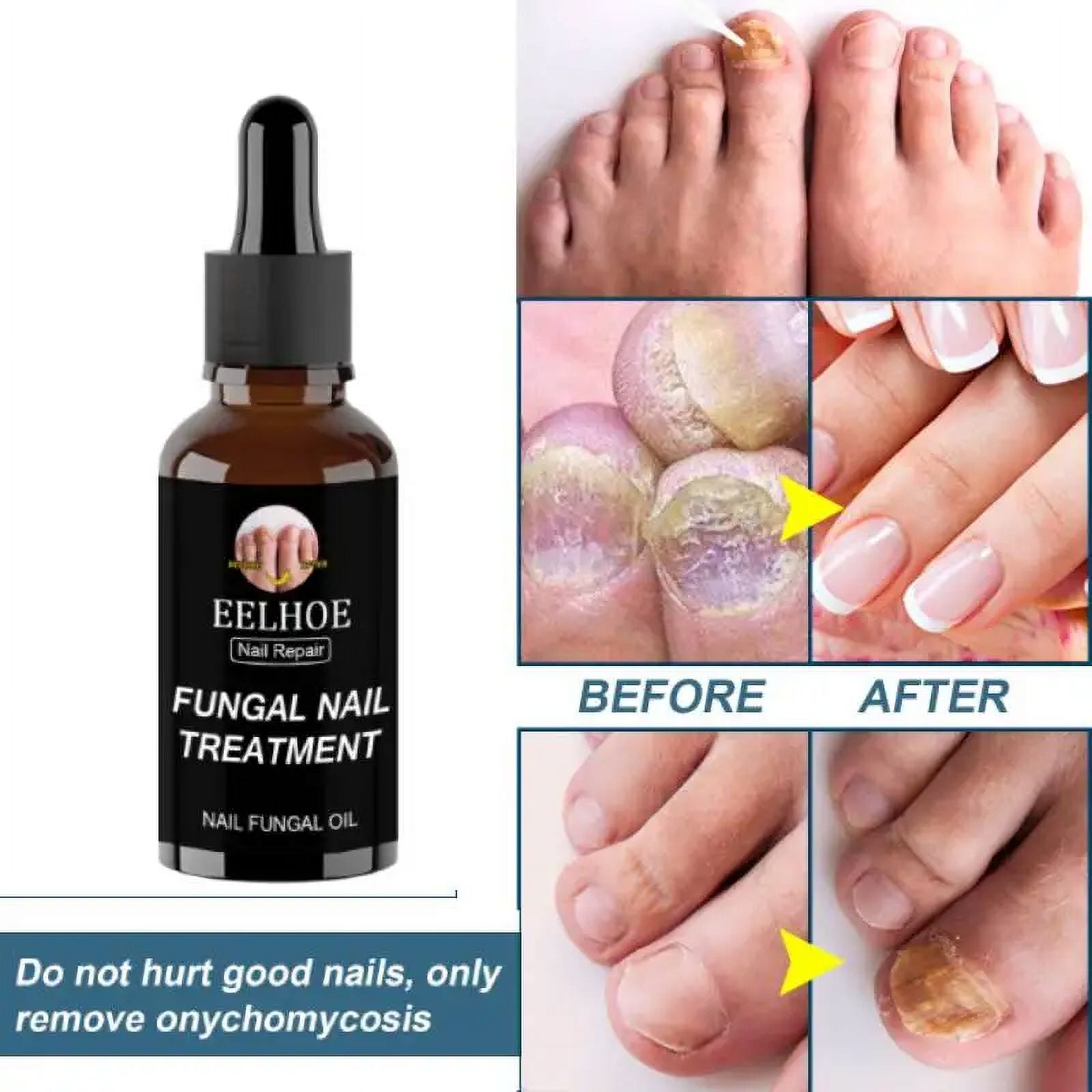 50ml Fungal Nail Treatment Essential Oil Hand & Foot Whitening Toe Nail