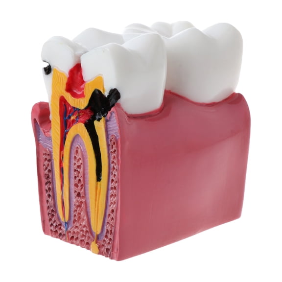 6 Caries Comparation Anatomy Teeth Model for Dental Anatomy Lab Tea