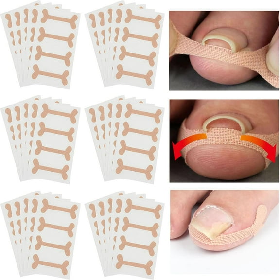 60 Sheet Professional Ingrown Toenail Corrector Patch Elastic Force Sticker Repair Bandage, Ingrown Toe Nail Corrector Paronychia Correction Tool Toenails Straightening Recover Strips Foot Care