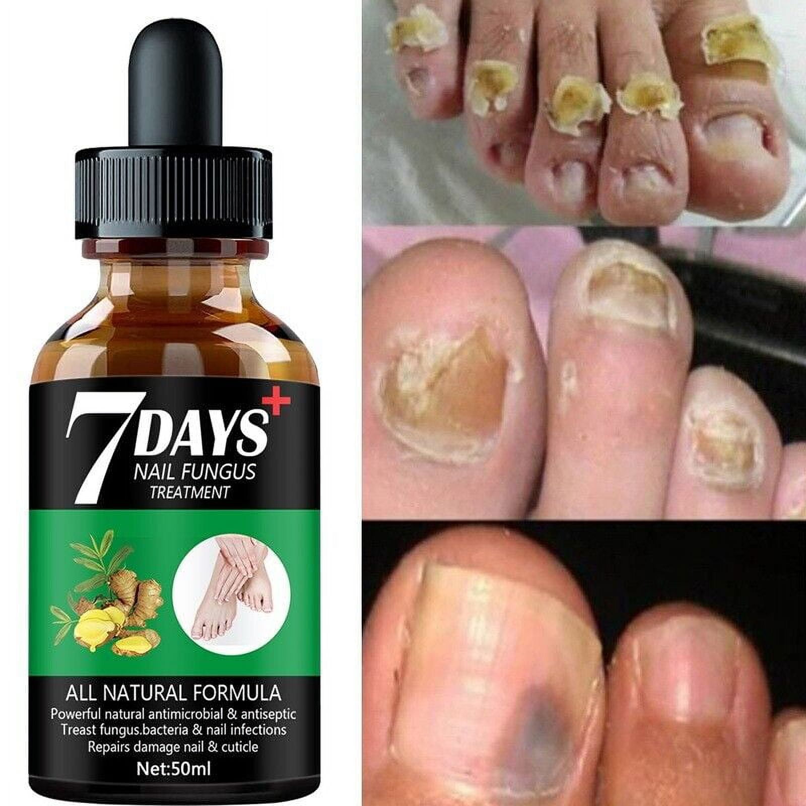 20ml Nail Fungus Treatment Toenail Fungus Treatment Extra Strength  Effective Fingernail Antifungal Nail Repair Fluid Toenail Repair Treatment  Extra Strength Thick Brittle Damaged Discolored Nails Restoring Healthy  Nails Prevent Reinfection | 90