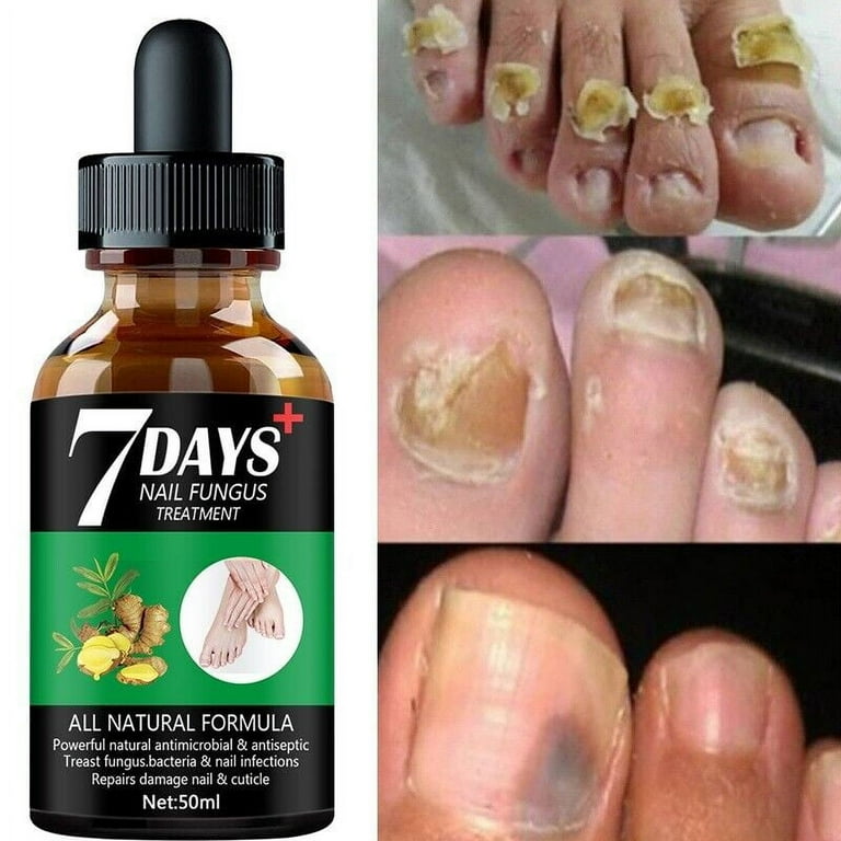 7 Days Nail Fungus Treatment Hand Foot Care Removal Repair Gel Anti infective