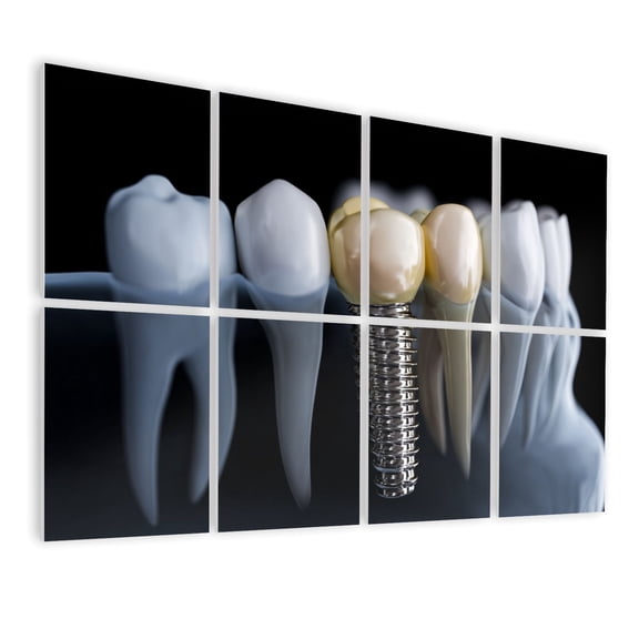 8 Pack Art Acoustic Panels Sound Absorbing Closeup dental implant jaw Decorative Soundproof Wall Panels Self Adhesive for Nursery Game Room Bedroom 48"x32"