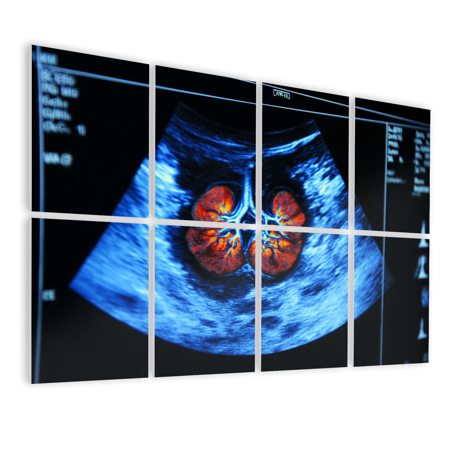8 Pack Art Acoustic Panels Sound Absorbing Kidney ultrasound effect ...